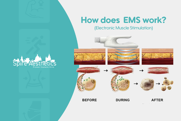 EMS treatment for post pregnancy weight loss treatment Cheltenham