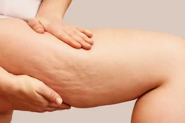 Image of woman showing leg with cellulite Cheltenham
