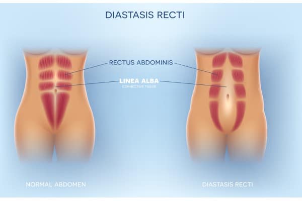 What Non-Surgical Options Are Available for Diastasis Recti Cheltenham?