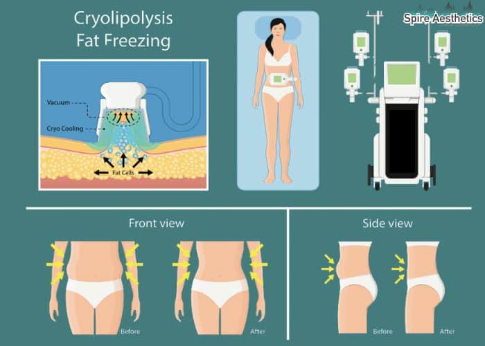 Image of diet and fat freezing combined for best results for Spire Aesthetics Cheltenham