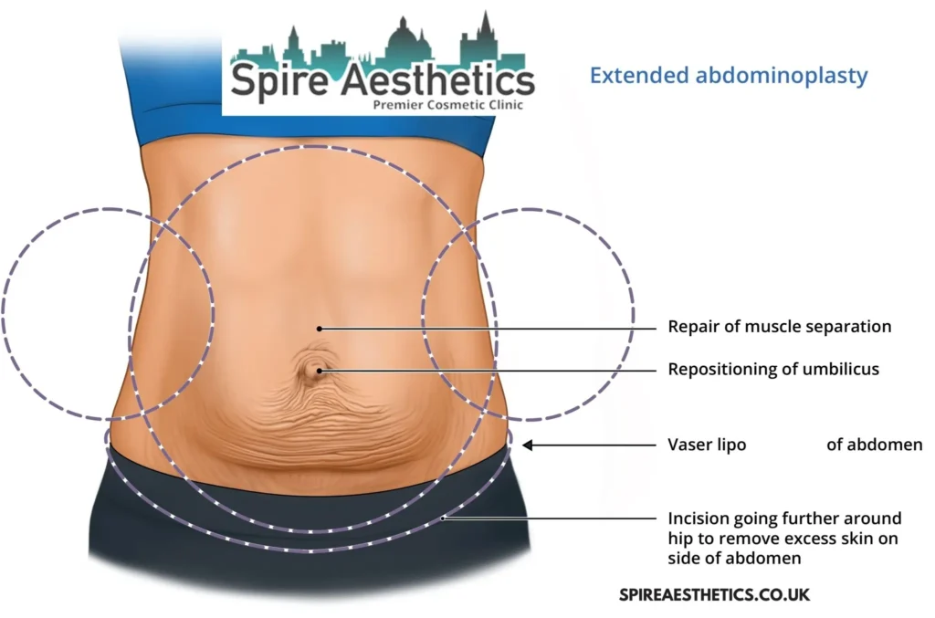 Understanding Loose Skin After Gastric Band Cheltenham Surgery and HIFU Treatment
