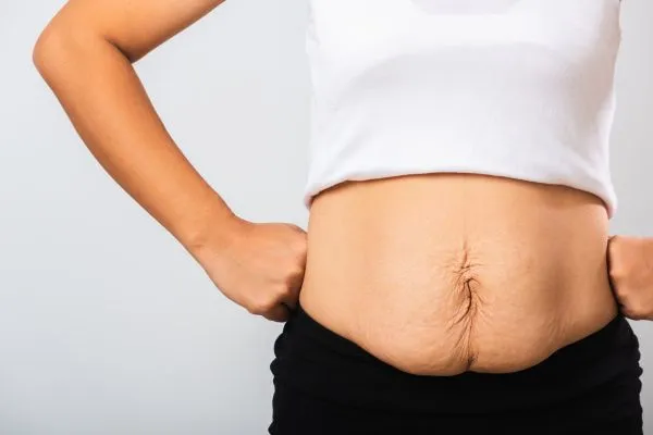 Image of a woman's stomach after weight loss with sagging skin following a gastric band Cheltenham
