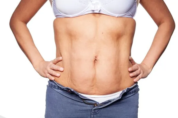 sagging skin on woman's stomach after weight loss injections Cheltenham