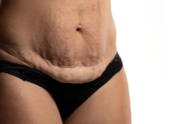 Image of womans stomach after weight loss injections Cheltenham showing saggy skin