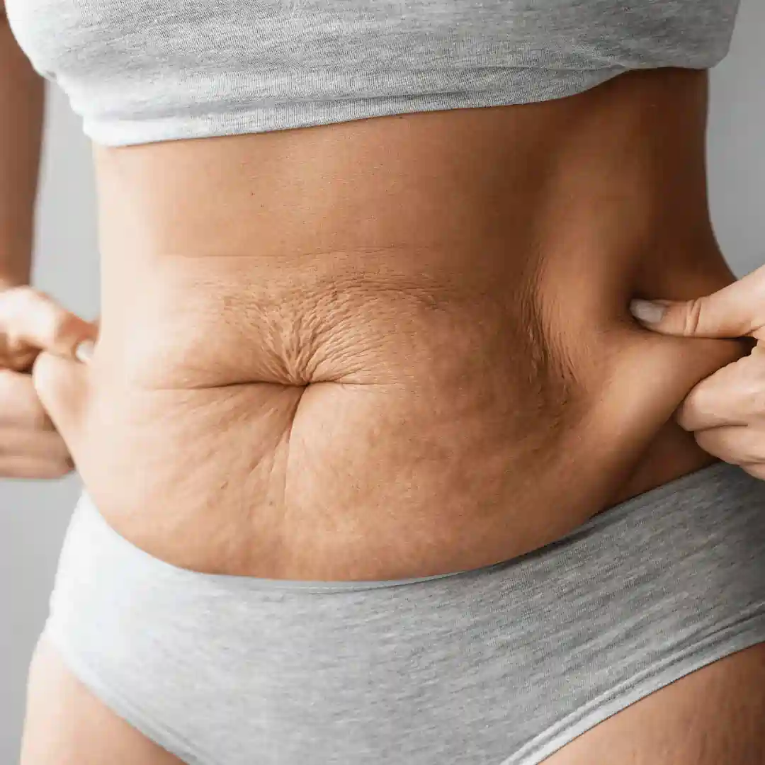Is It Normal to Have Loose Skin After Pregnancy Cheltenham?