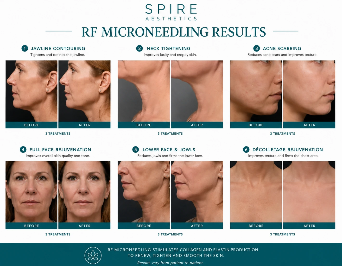 RF Microneedling Skin tightening Cheltenham results