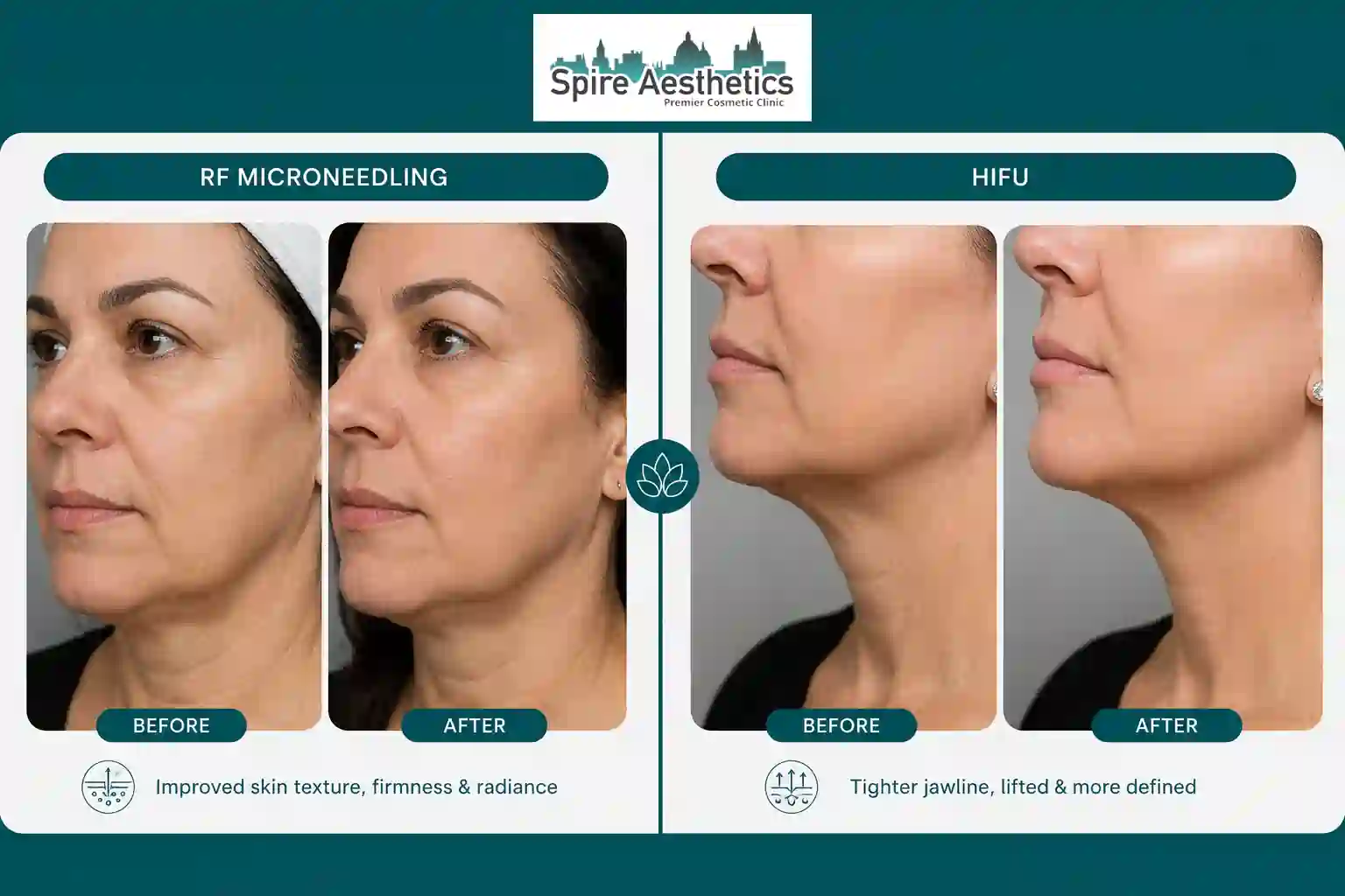 Can RF Microneedling and HIFU Be Combined Cheltenham?