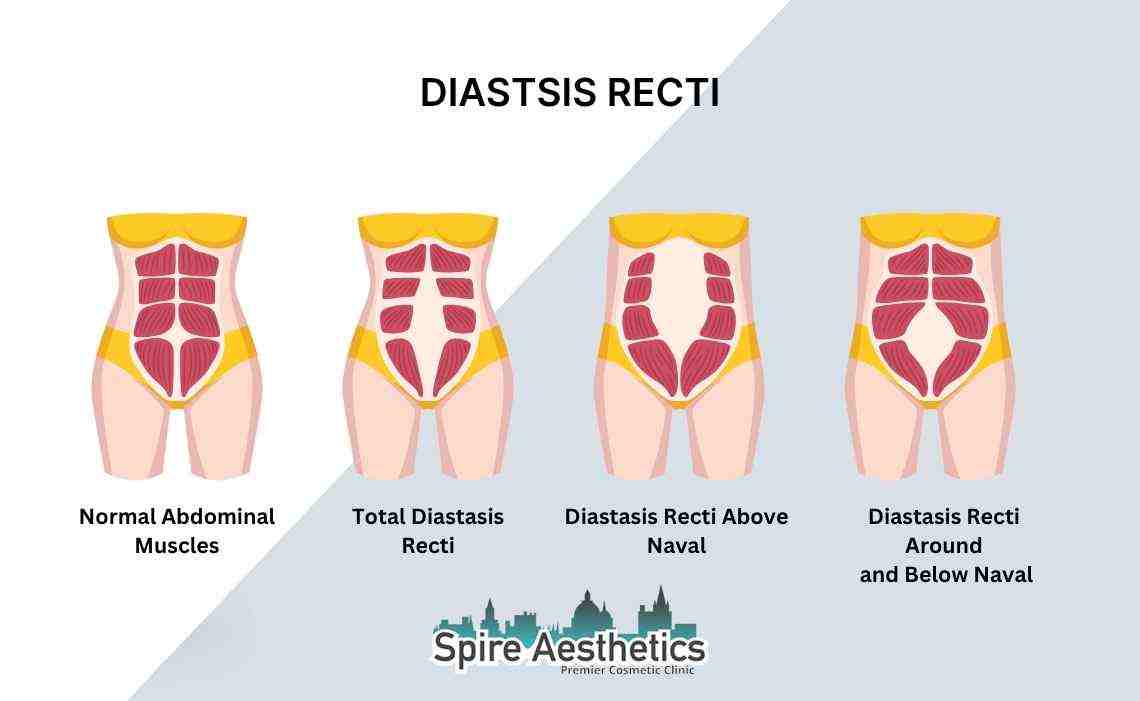 Is Non-Surgical Diastasis Recti Treatment Right for You? Common Concerns Answered Cheltenham